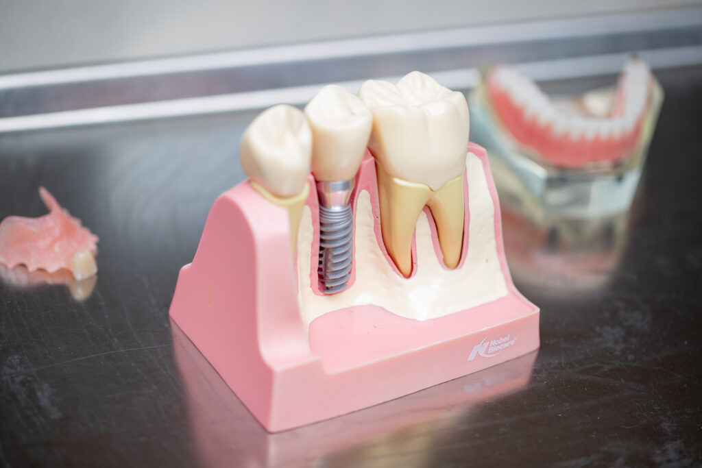 Example of what a dental implant looks like. What does a dental implant look like?