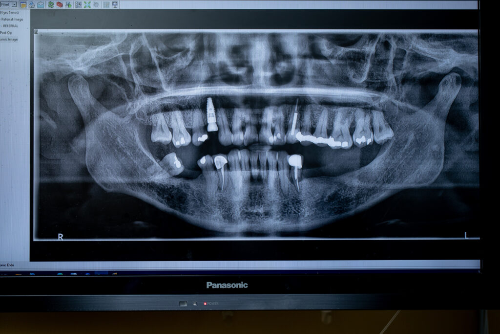 X-ray showing teeth for oral surgery procedure such as dental implants or wisdom teeth removal