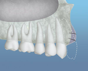 example of a bone graft being placed to help with a dental implant
