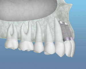 An example of dental implants being placed after a bone graft