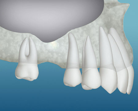 An example of bone loss where a bone graft would be needed