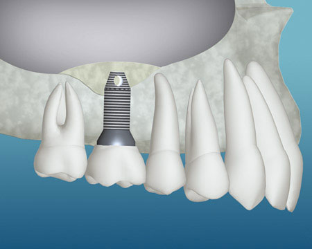 An example of an dental implant being placed after a successful bone graft