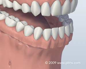 An example of a denture used to replace missing teeth