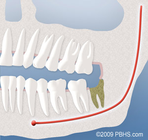 An example of why dry socket occurs after a tooth extraction or wisdom tooth removal