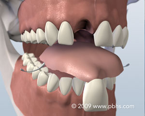 An example of a "flapper" tooth replacement. These are temporary and made of plastic.