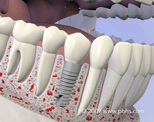 An example of a dental implant. Dental implants are one of the most comfortable replacement options to teeth.