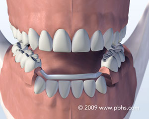 A metal partial denture created from metal and plastic is a less fragile choice for a temporary tooth.