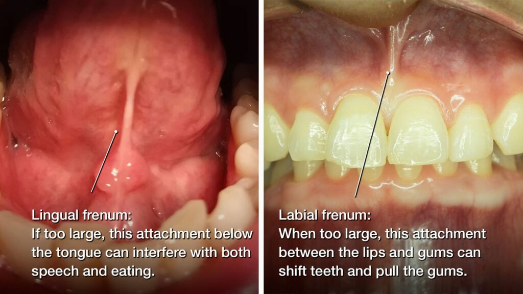 An example of when a frenectomy would be needed