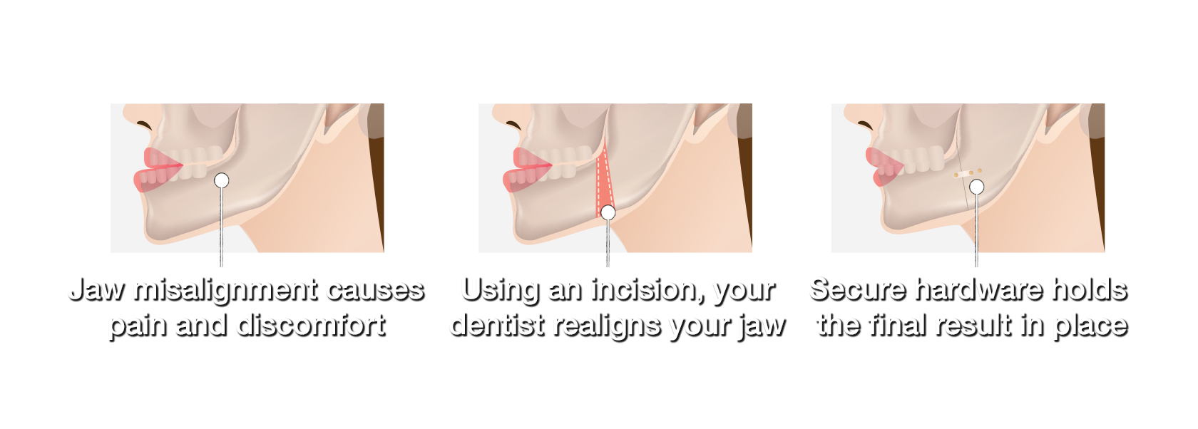 Graphics showing the importance of corrective jaw surgery on a misaligned jaw